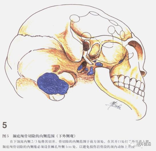 扩大颅中窝入路手绘图