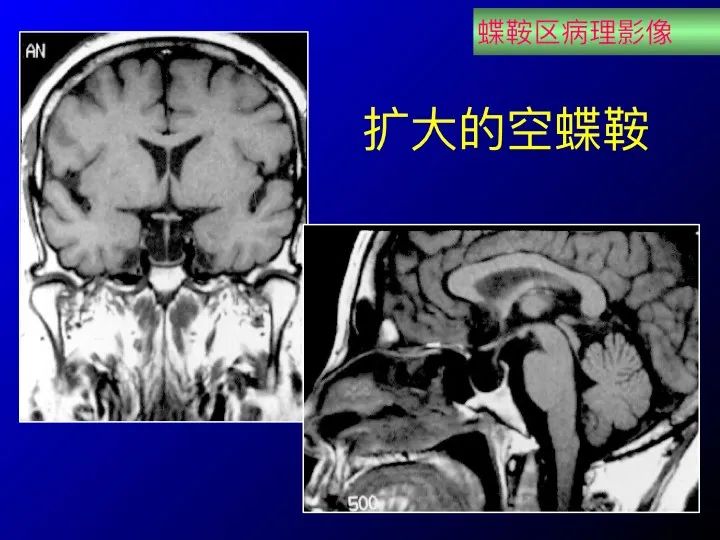 【推荐】鞍区应用解剖 断层解剖图谱