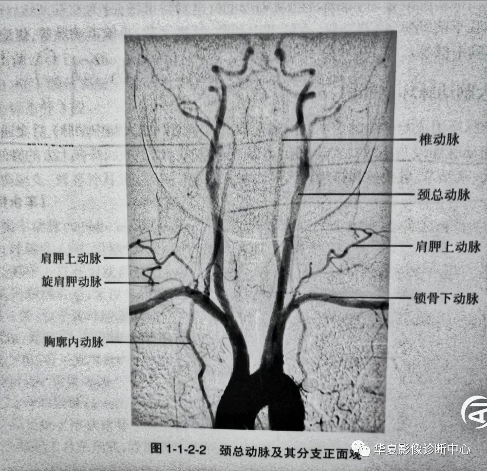数字减影血管造影dsa下头部二三级动脉血管解剖影像下载保存
