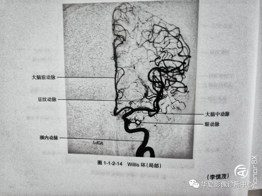 大脑动脉环由成对的大脑前动脉交通前段,大脑中动脉,后交通动脉及