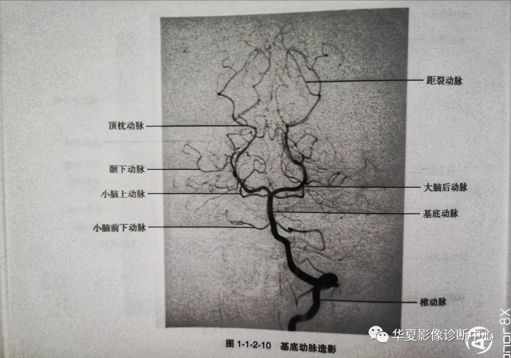 数字减影血管造影dsa下头部二三级动脉血管解剖影像下载保存