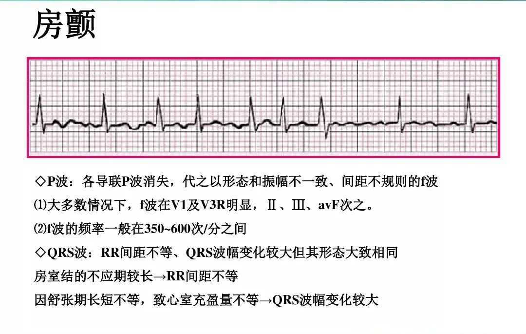 掌握这6项心电图干货,波形判断不再难!_心室