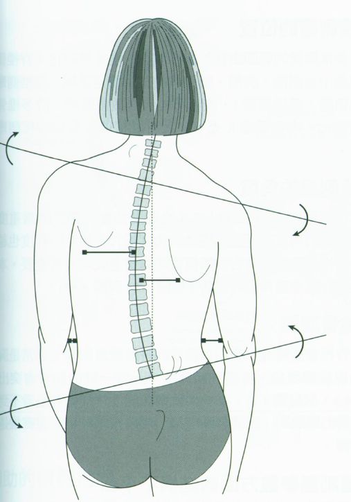 星61知识脊柱侧弯的运动纠正方法