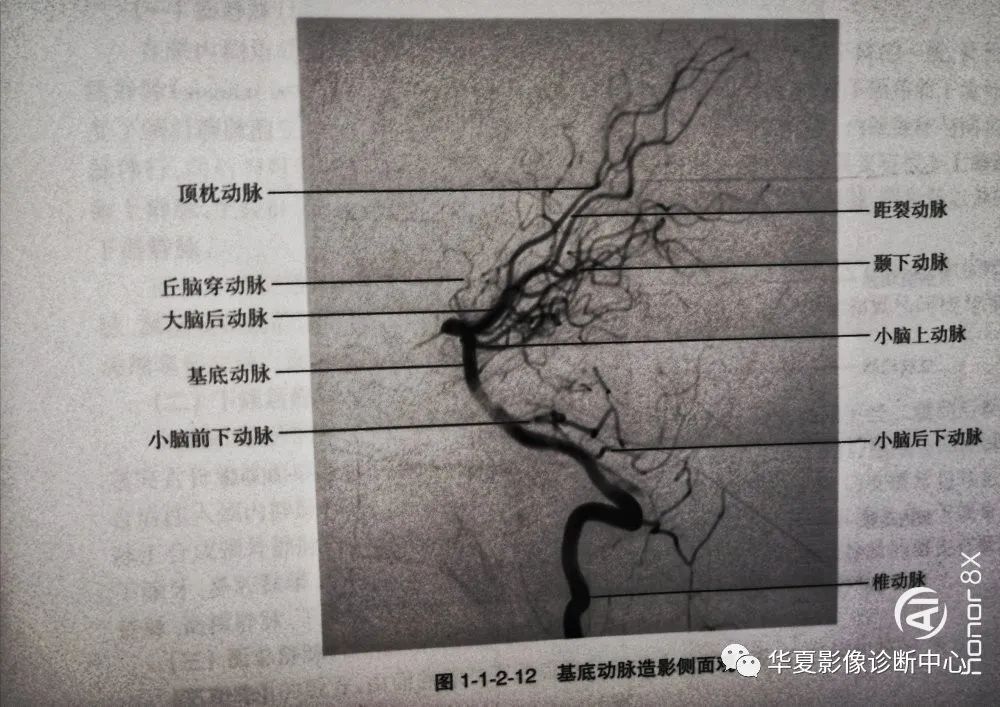 数字减影血管造影dsa下头部二三级动脉血管解剖影像下载保存