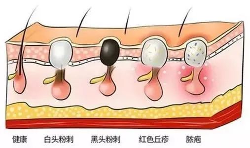 痘痘在临床上被称为痤疮 是由于皮肤油脂分泌旺盛 不及时处理, 新增