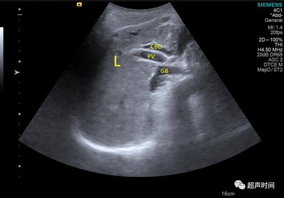 超声检查显示胆囊窝未见胆囊显像,多角度扫描发现胆囊向下向后走行