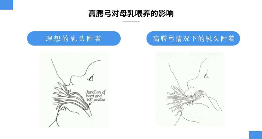 高腭弓时含乳情况