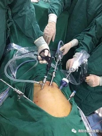 64岁腔镜下胃癌根治术