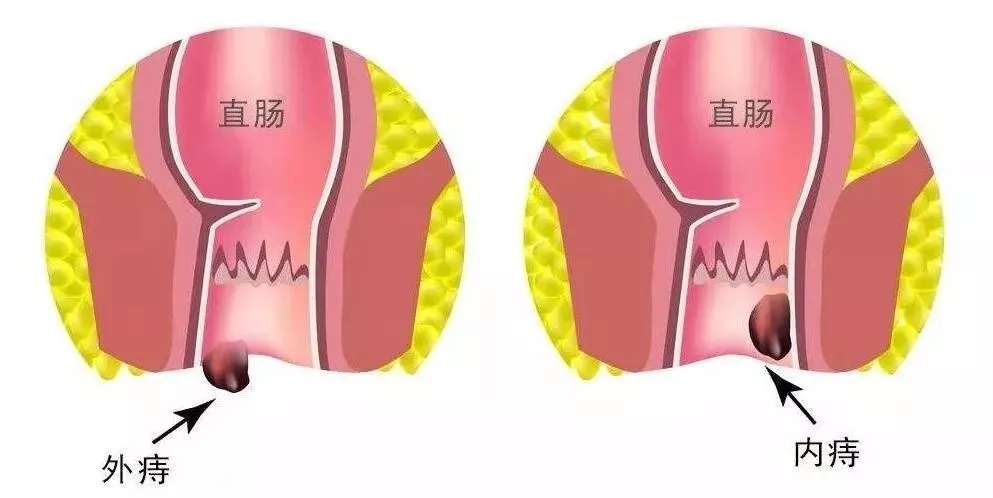 痔疮会自愈?拖一阵子就会自己好吗?