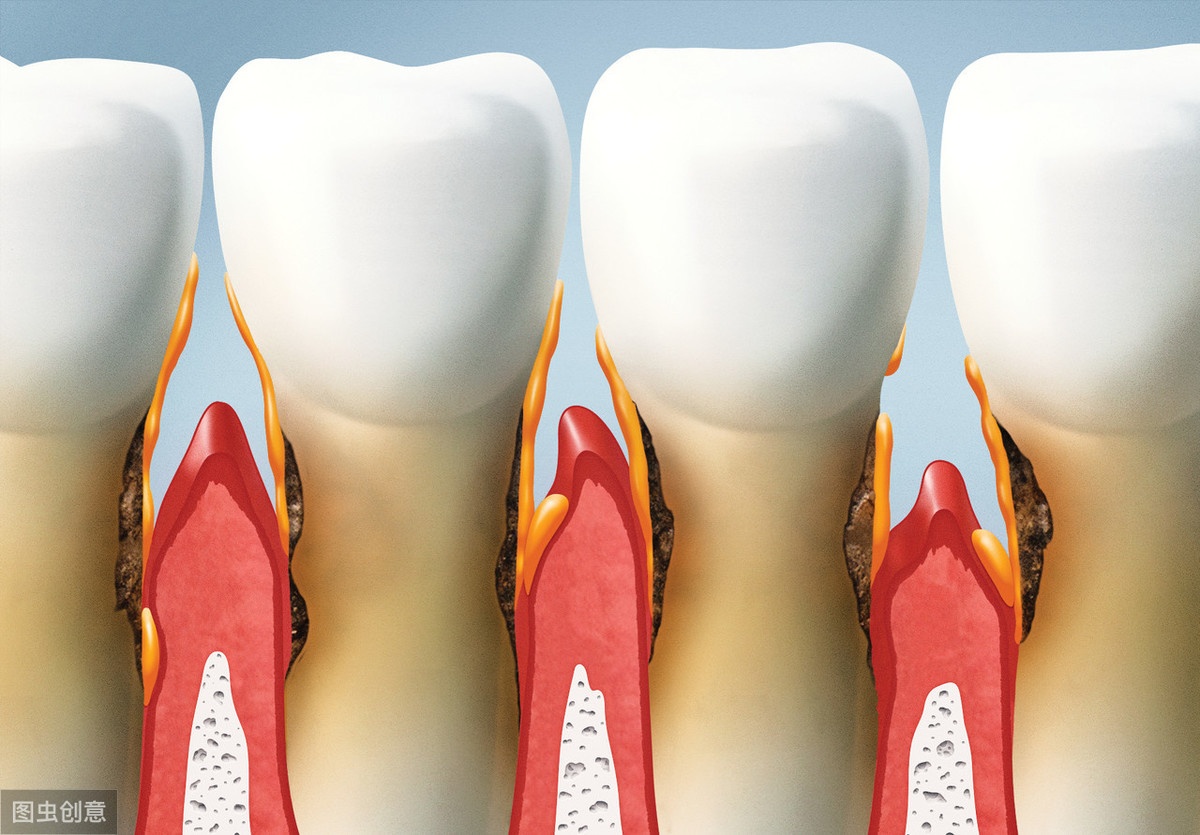 牙根经常发炎怎么办