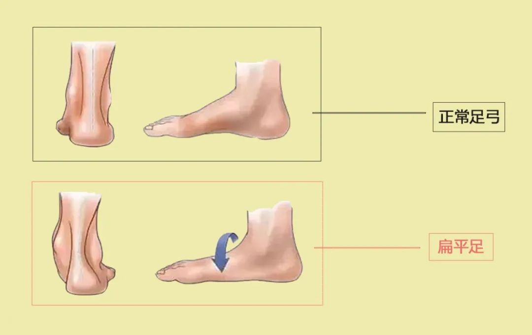 久站脚痛,走路内八,都是扁平足在作怪!