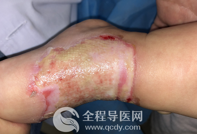 2岁娃腿烫伤自敷草药治疗致高热惊厥-儿童医院烧伤科医生谈:烫伤应