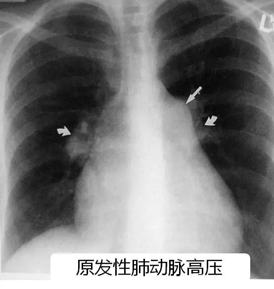 肺动脉高压4. 肺水肿(pulmonary edema)编辑3.