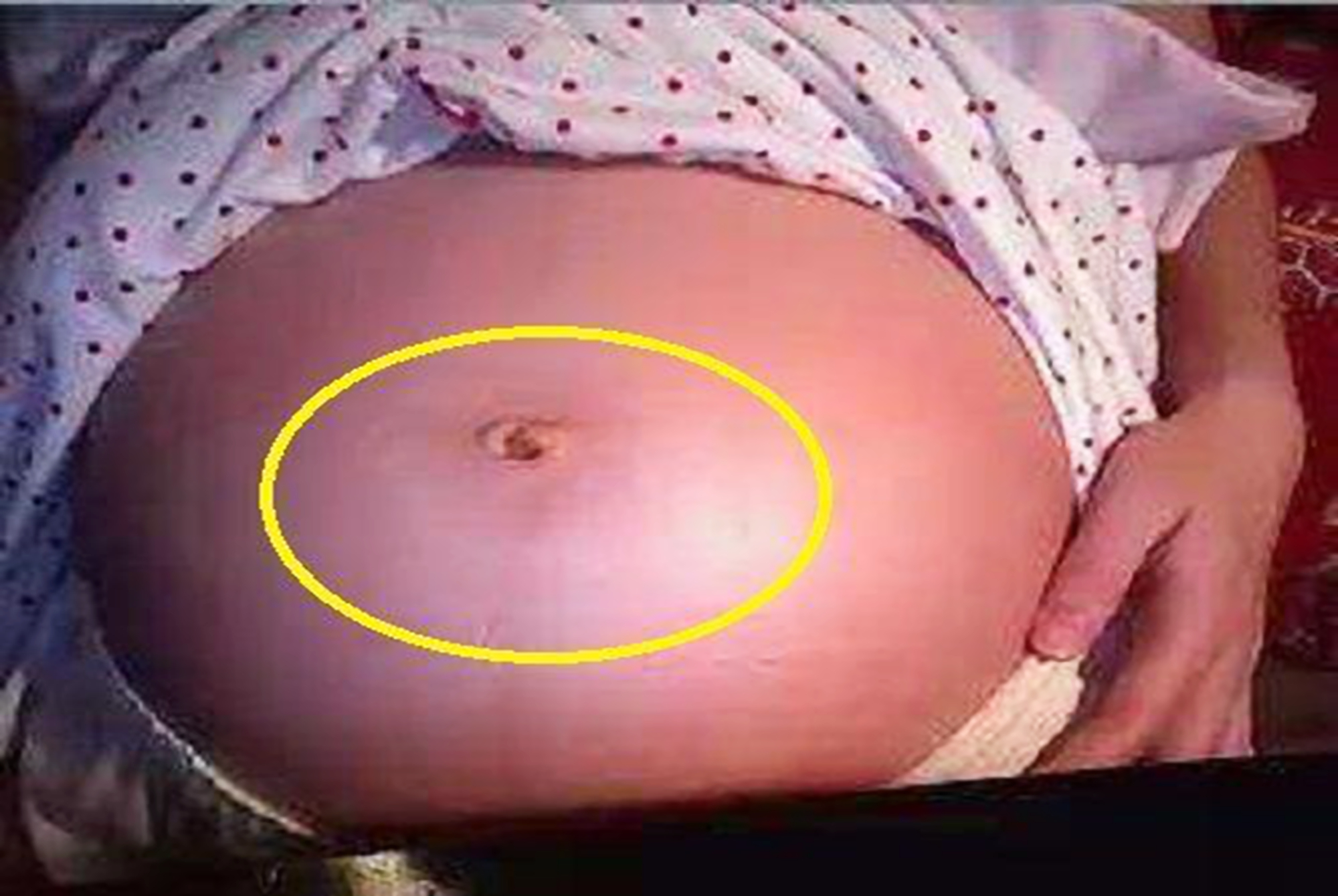 孕妈肚脐的凹和凸说明了什么？这种状态很有福，孕妈们不必担心