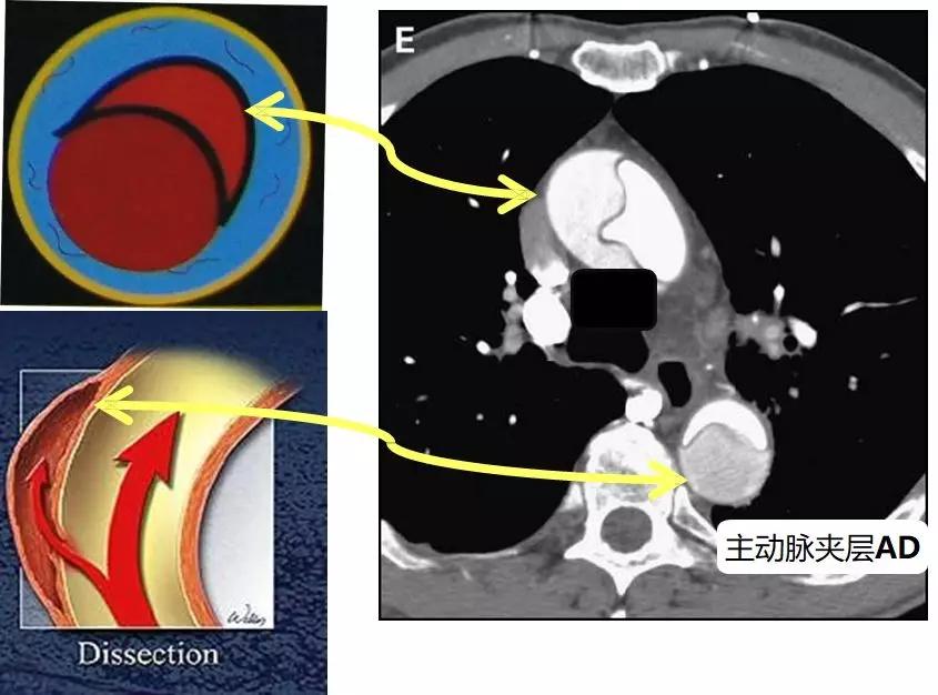 主动脉夹层(ad)