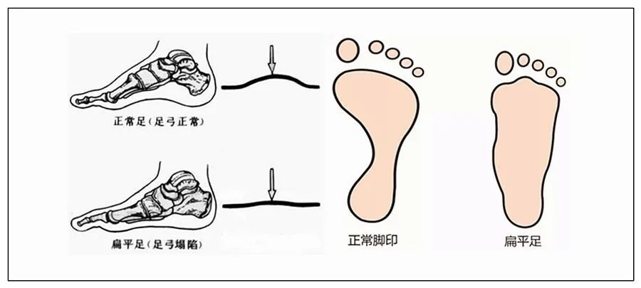 扁平足穿鞋难看怎么办