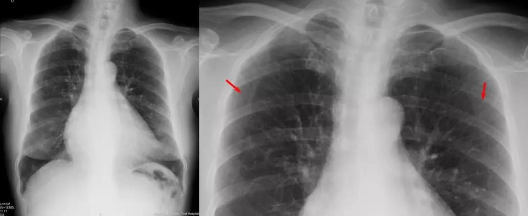 肺动脉高压(pulmonary hypertension ) 4 x线的其他应用 ◆心脏手术后