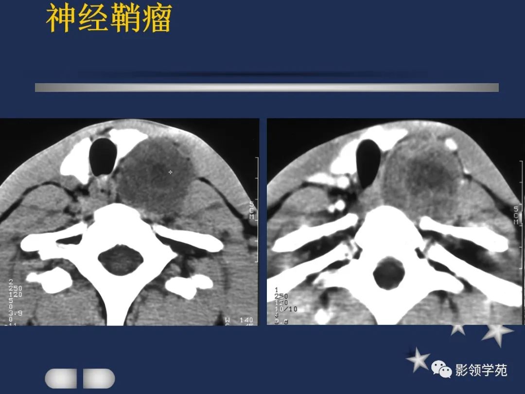 肿瘤常突破甲状腺被膜向周围侵润;在增扫时可见环状强化;由于ct和mri