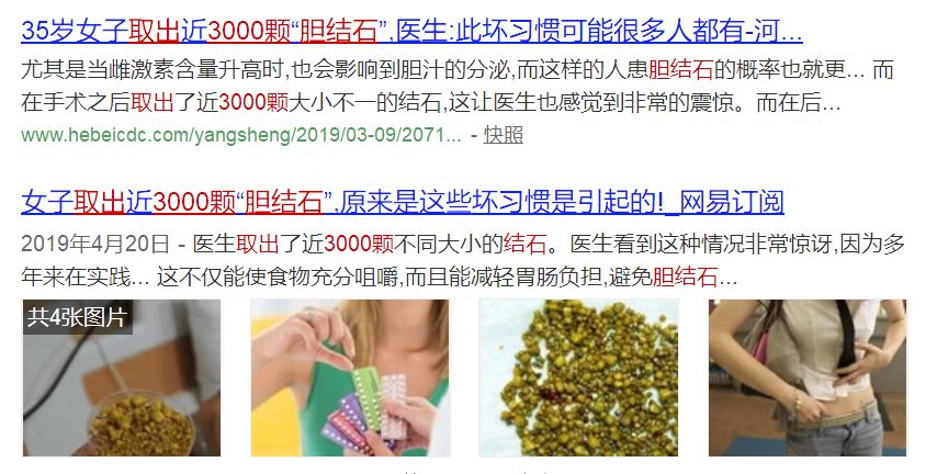 女子取出近3000颗胆结石原来是这些坏习惯是引起的