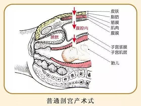 腹壁肌层,腹膜层,子宫浆膜,子宫肌层,缝取出宝宝后再逐层缝合,医生