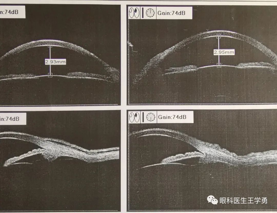 瞳孔扩大开角型青光眼,发病隐匿,除少数患者在眼压升高时出现雾视,眼