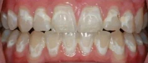 牙齿上有白斑是因为缺钙?补钙就能好?