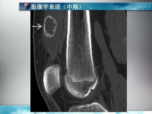 骨化性肌炎的影像学诊断