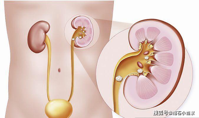 哺乳期肾结石怎么办啊