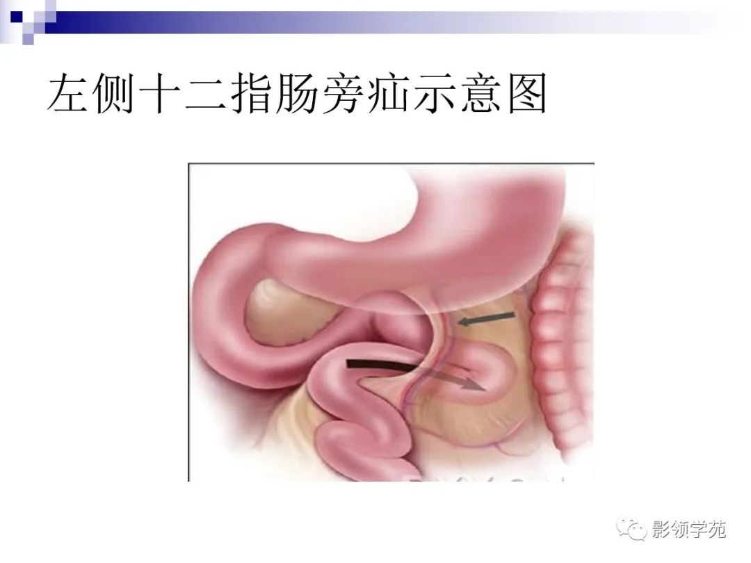 7种类型腹内疝的影像学表现