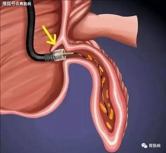 不开刀也能治疗阑尾炎,这种疗法值得推荐——内镜下erat术