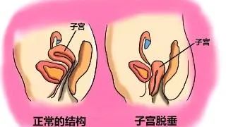 进一步下降,脱垂症状会进一步加重,此时患者可自觉有阴道内肿物脱出