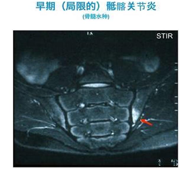 膝关节骨髓水肿怎么办