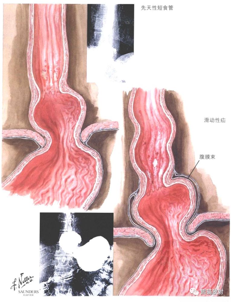 食管裂孔疝:滑动性及贲门旁