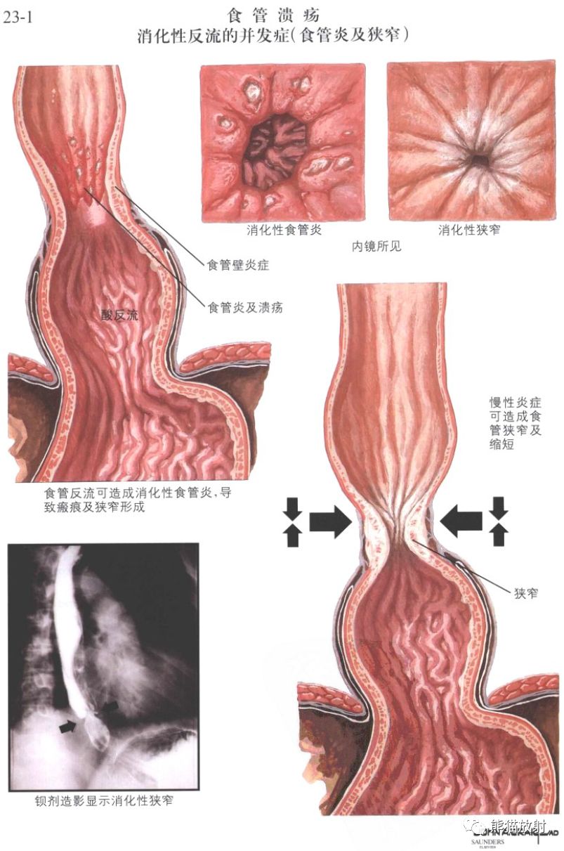 食管相关疾病丨奈特图解,直观易学