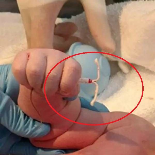 宝宝“攥着”避孕环出生，让医生吃惊！为啥上了节育环还会怀孕？