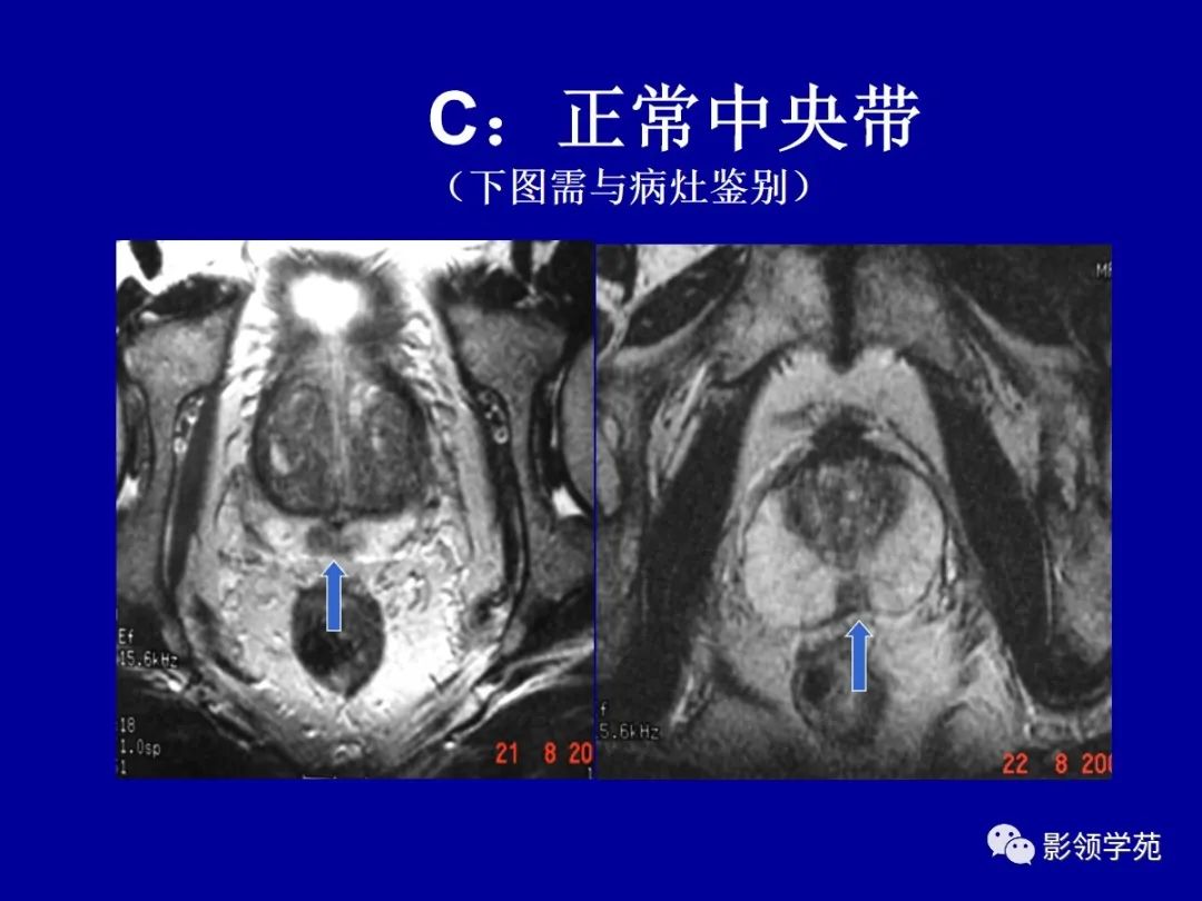 前列腺解剖及mri影像表现