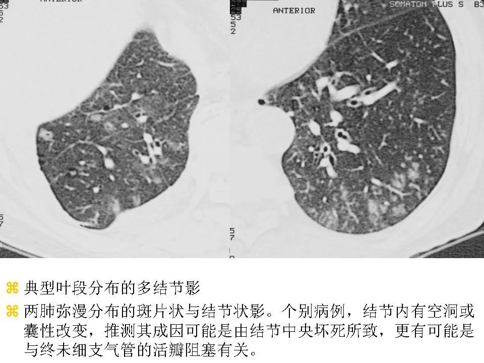 细支气管肺泡癌的影像学