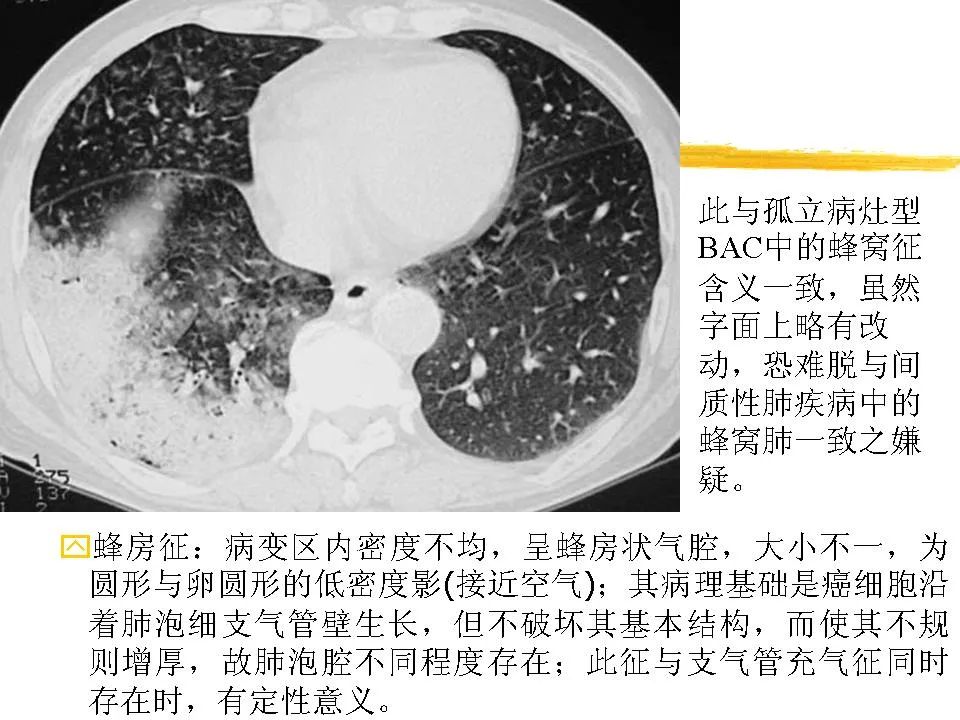 细支气管肺泡癌的影像学