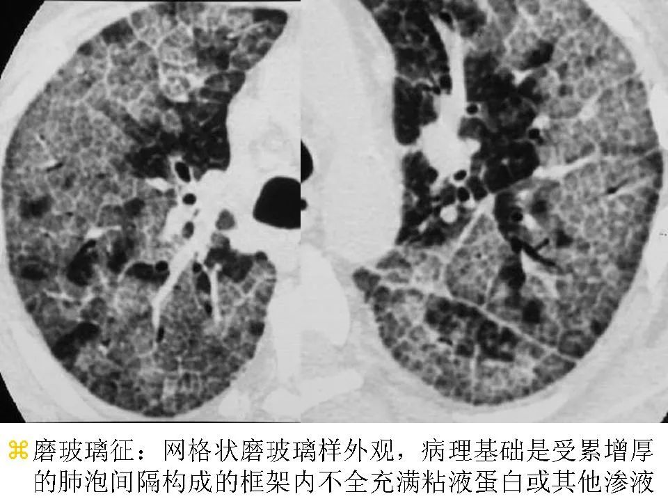 细支气管肺泡癌的影像学