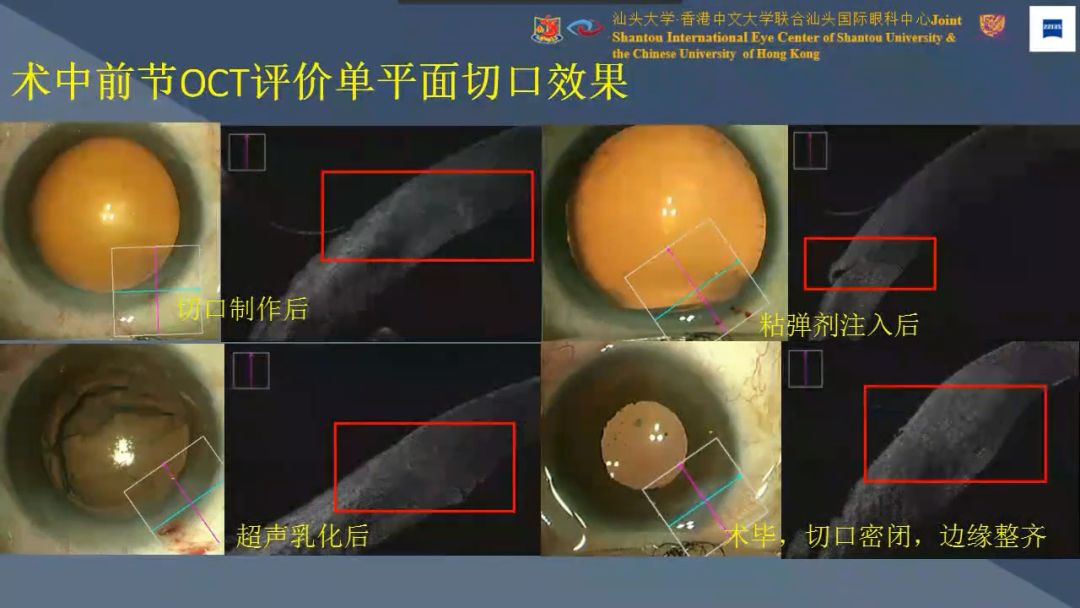 【学无止境,蔡司伴您共成长】白内障显微手术精益训练