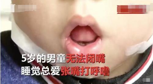 #嘴巴#张嘴呼吸的孩子会越长越丑吗口罩下的宝宝都是张着嘴巴的
