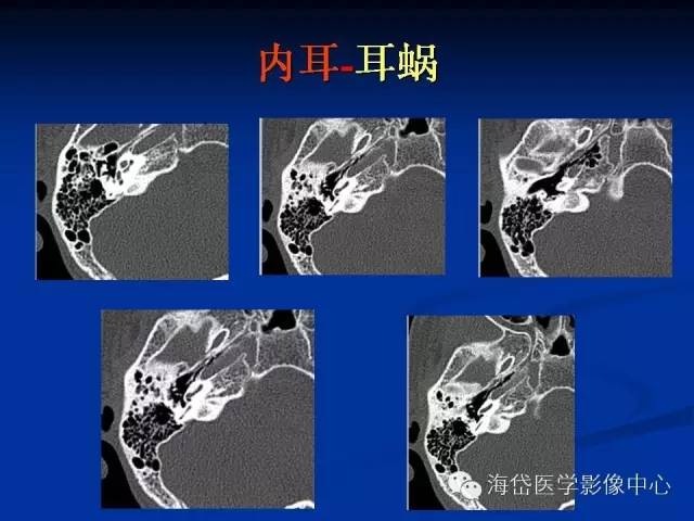 耳部ct及mri解剖