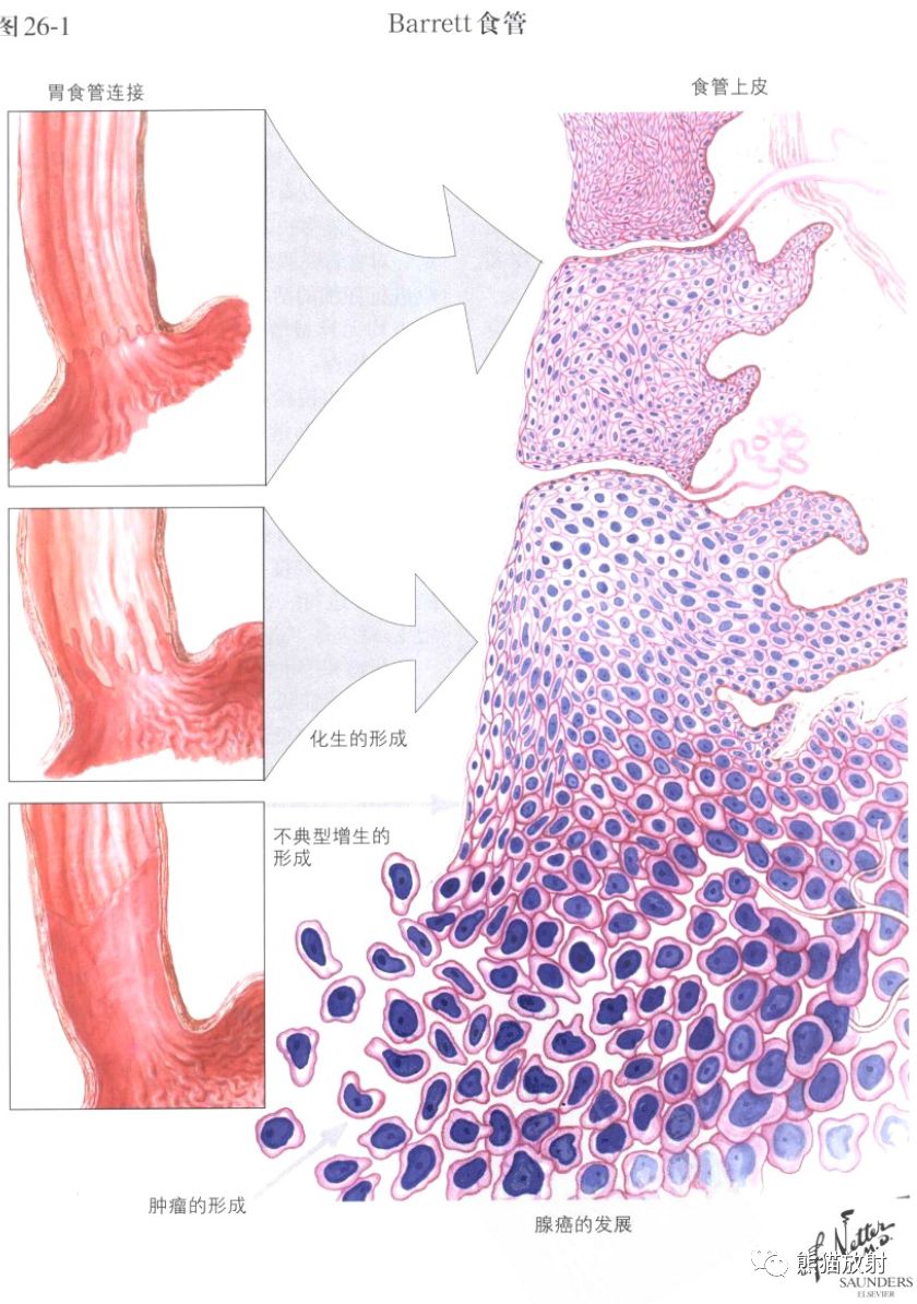食管相关疾病丨奈特图解直观易学