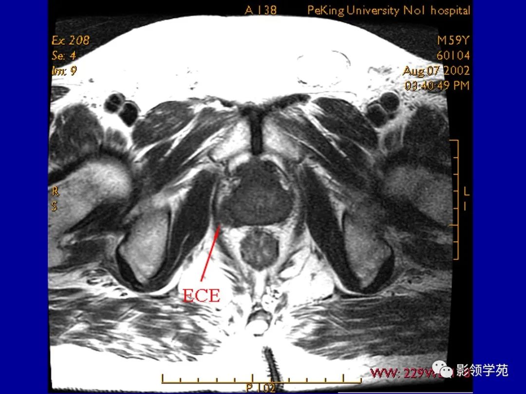 前列腺解剖及mri影像表现