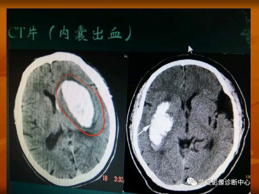 ct如何区分脑淀粉样变脑出血与高血压性脑出血