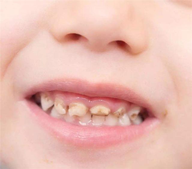 发现龋齿及时诊治当父母发现孩子的牙齿上存在小的黑色斑点时,应该
