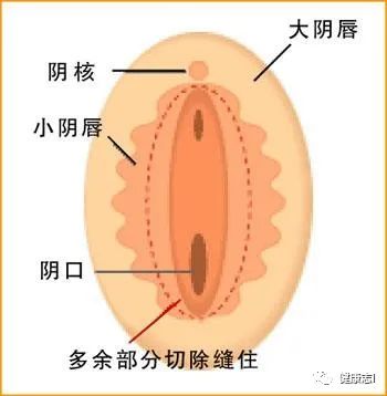你真的知道外阴炎是什么吗？女性该如何呵护自己