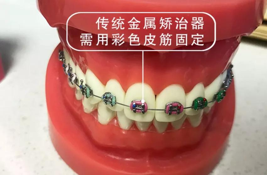宝安干货关于牙套二三事金属陶瓷自锁托槽隐形牙套的优缺点有哪些