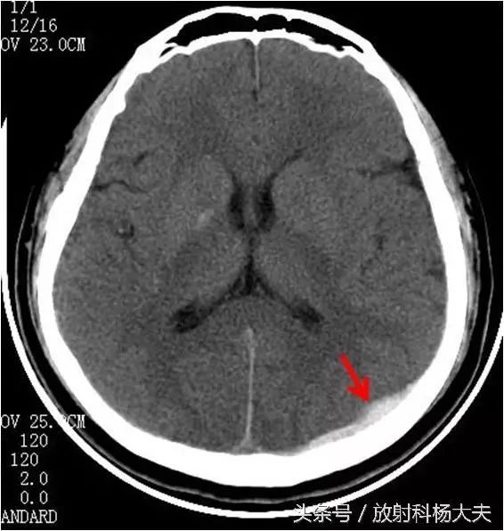 上面一排图,红箭所示白色的东西就是硬膜下的血肿