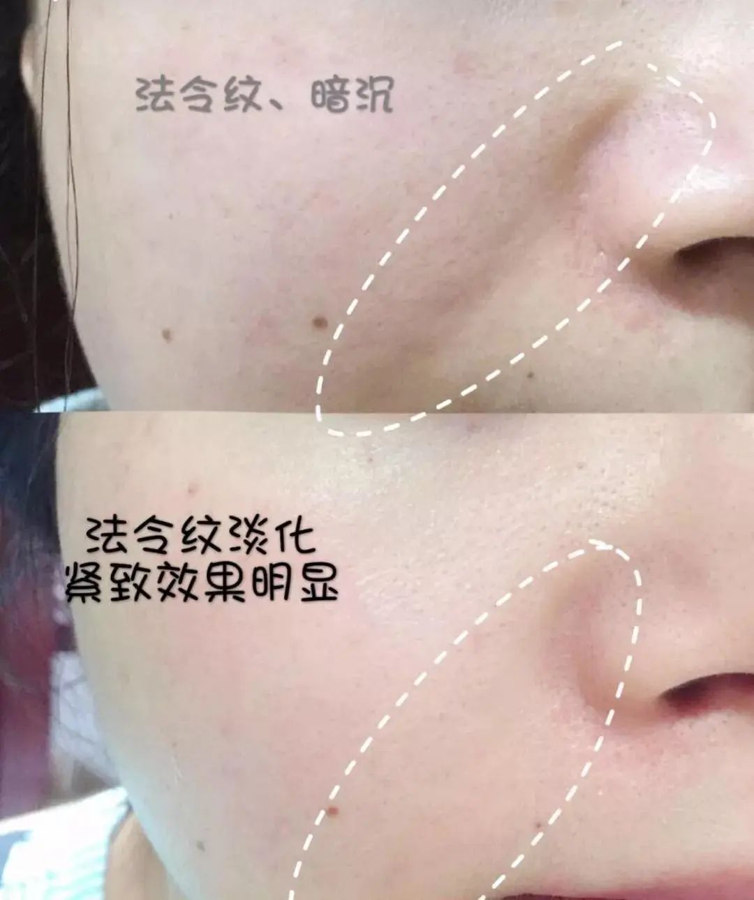 放大20倍拔黑头是什么体验?看着油脂污垢抽离毛孔的那